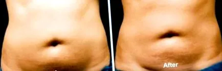 coolsculpting