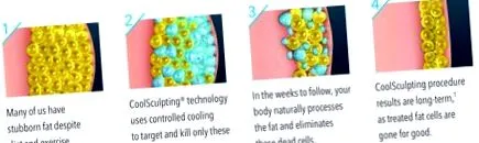 coolsculpting