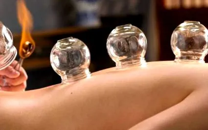 cupping
