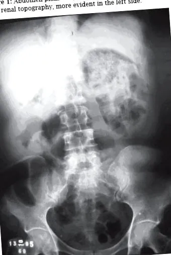 pyelonephritis