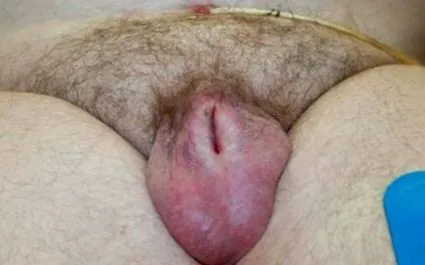 penisului