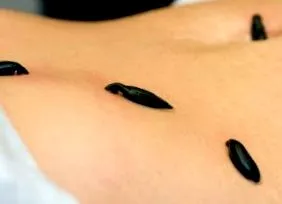 Terapia lipitorilor