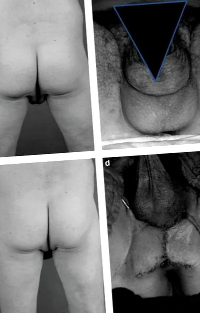 lipomatoza
