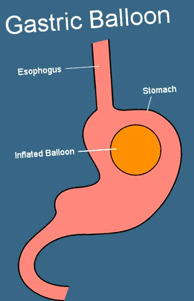 baloane gastrice