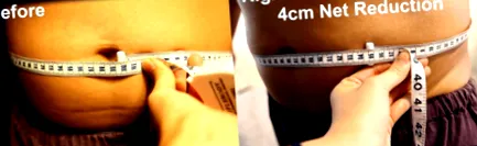 нехирургична липосукция