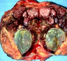 pheochromocytoma columbia