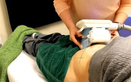 coolsculpting