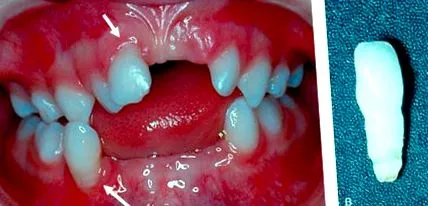 cementum