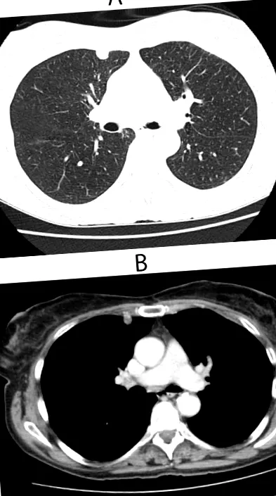 pulmonalis