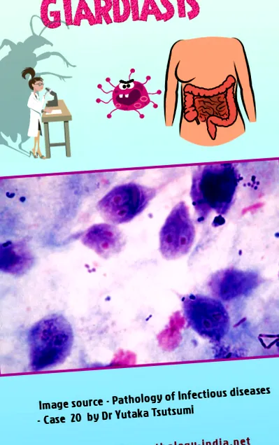 giardia epehólyag