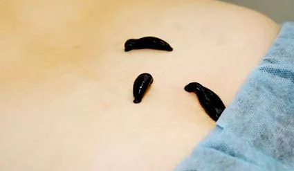 piócák