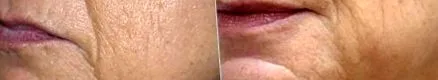 стандартния протокол инжекционна
