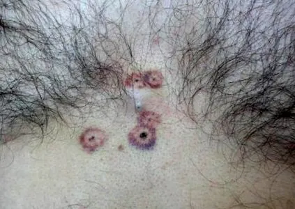 terapia