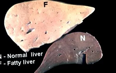 hepatice