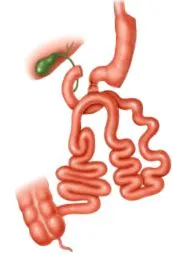 duodenal