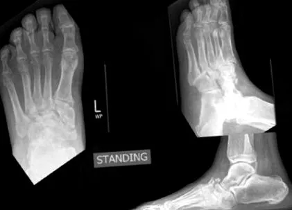 acut Charcot