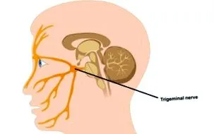 neuralgia