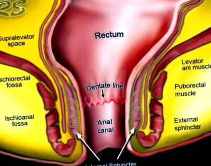 fistulele