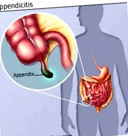 apendicita