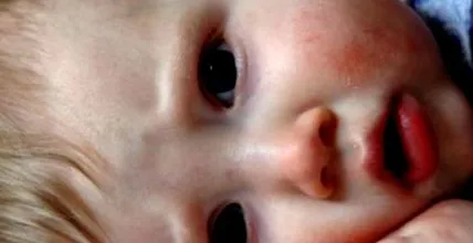 eczema