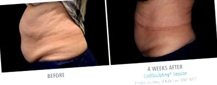 coolsculpting преди