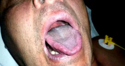 simptome