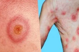 erythema