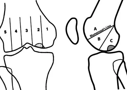 osteocondrita