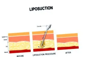 lipo után