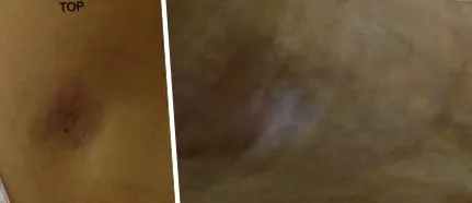 lipoatrophia