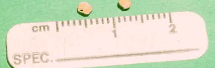 stones struvite
