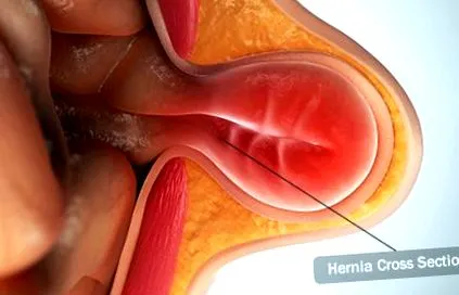 hernias