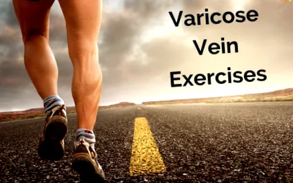 varice