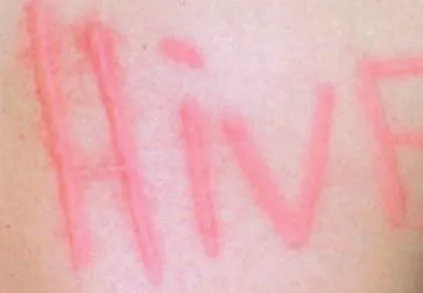 hives