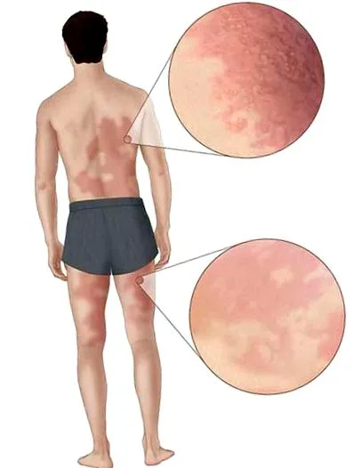 allergy