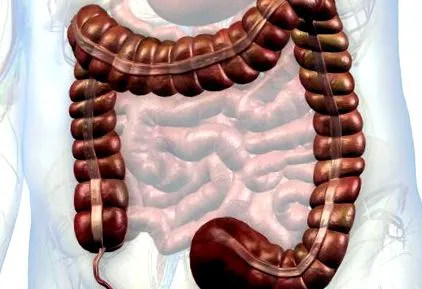 apendicita