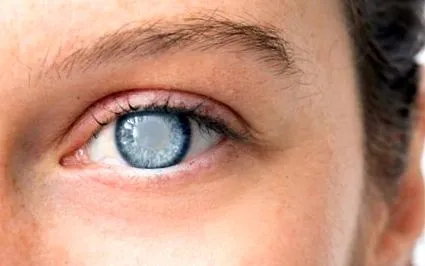 cataracta