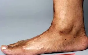 lábak