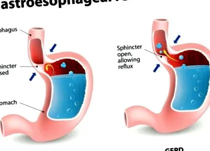 gastroesophagealis