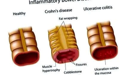 boala Crohn