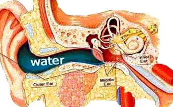 tinnitus