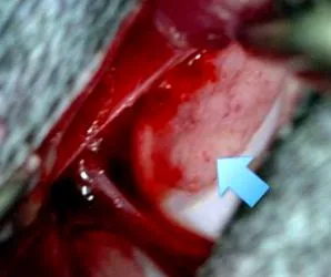 osteocondritei