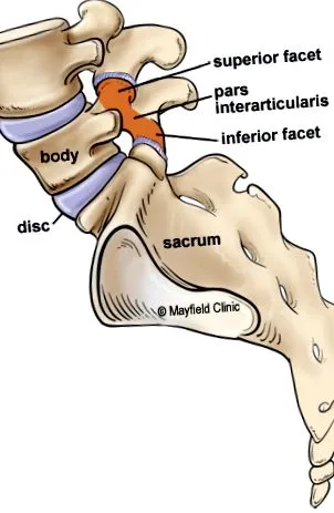 spondylolisthesis
