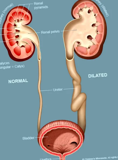 dilatarea