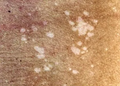 tinea
