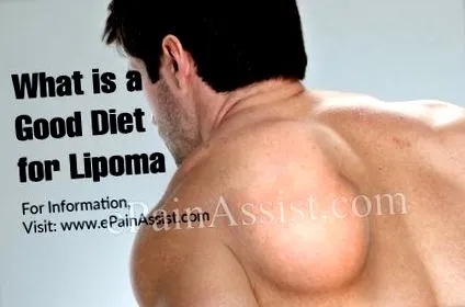 lipoma