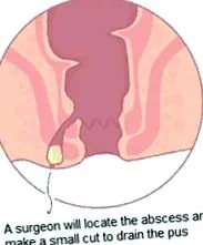 абсцес crohn