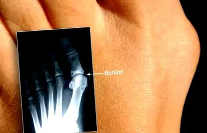 bunion