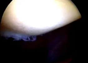 patella