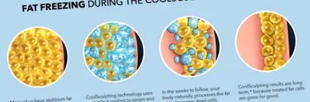 coolsculpting
